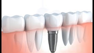 implant tedavisinin detaylı aşamaları 2 diş için [upl. by Minsk399]