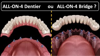 All on 4  Type de prothèse  Dentier ou Bridge [upl. by Nuahsyd]