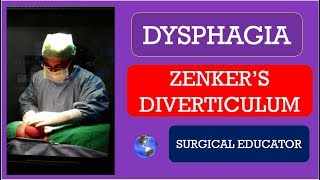 ZENKERS DIVERTICULUM  How To DIAGNOSE amp TREAT DYSPHAGIA [upl. by Kennedy284]