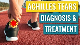 Achilles Tendon Tears  Diagnosis and Treatment of Complete Ruptures [upl. by Navis]