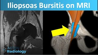 Pes Anserine Bursitis Vs Medial Meniscus Injury [upl. by Beffrey618]