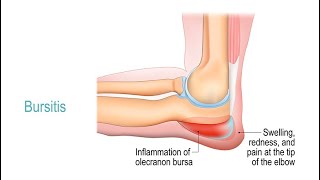 Treating Bursitis [upl. by Aidnis]