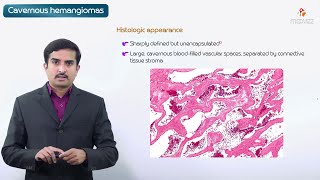 Cavernous hemangioma  Pathology Usmle step 1 [upl. by Ayetal]