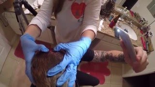 At Home Pilar Cyst Removal [upl. by Ahsinek]