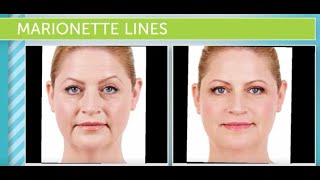 Treating Marionette Lines At Hermann Wellness [upl. by Einttirb]