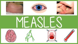 Measles  Features Management and Mnemonics [upl. by Ylnevaeh]