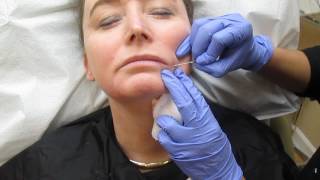 Dr Saluja  Juvederm filler  Micro Cannula  Marionette Lines amp Oral Commissures [upl. by Barnet]