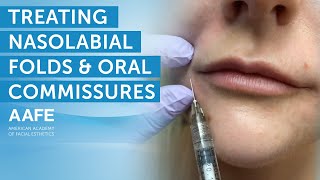 Using Dermal Fillers to Fill and Smooth Smile Lines  AAFE [upl. by Lednahc]