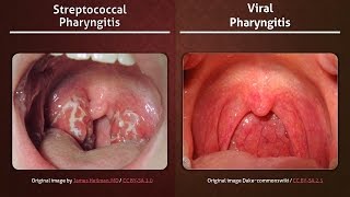 Streptococcal vs Viral Pharyngitis [upl. by Trauner]