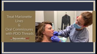 Treating Marionette Lines and Oral Commissures with PDO Threads [upl. by Leonelle206]