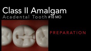 Class II Amalgam Preparation  18 MO Acadental Typodont [upl. by Frederigo596]