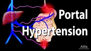 Portal Hypertension Animation [upl. by Drahsar]