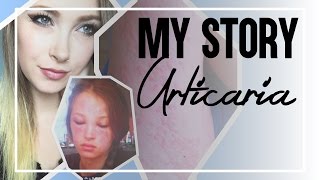 My Story Urticaria Chronic Idiopathic Hives [upl. by Assilem767]