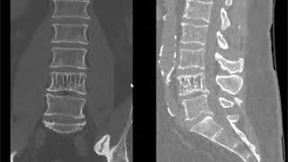 Spine lecture hemangioma of spine [upl. by Tsuda729]