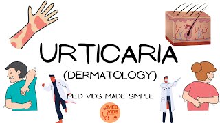 Urticaria  Dermatology Pathophysiologyclinical featuresdiagnosistreatment MedVidsMadeSimple [upl. by Anirtruc]