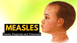 Measles rubeola Explained Clearly by MedCramcom [upl. by Anauqal]