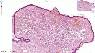 Capillary Hemangioma  Skin Histopathology [upl. by Afatsom727]