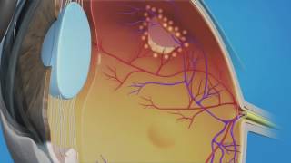 Prophylactic Laser Photocoagulation Laserpexy for Retinal Tear [upl. by Llednav]