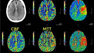 2Minute Neuroscience Brain Aneurysms [upl. by Hephzibah]