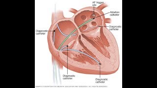 Tratamiento de arritmia ablación cardïaca por radiofrecuencia [upl. by Ameyn]
