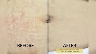 Fractional CO2 Laser Say Goodbye To Stretch Marks  Shinagawa Aesthetics [upl. by Katsuyama516]