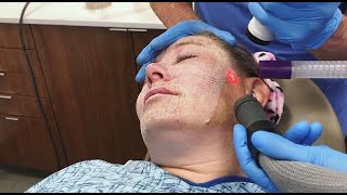 Full Face Fractional CO2 Laser Resurfacing for Wrinkles and Skin Tightening [upl. by Had]