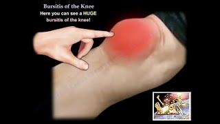 Diagnose and Manage Your Knee Pain Bursitis [upl. by Eivol]