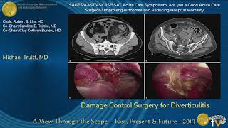 Diverticulosis and diverticulitis Simplified [upl. by Darreg]