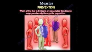 Measles  Everything You Need To Know  Dr Nabil Ebraheim [upl. by Rubma185]