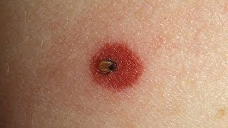 How to Spot Lyme Disease  WebMD [upl. by Wescott]