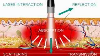 High Intensity Laser  Medical Effects [upl. by Oulman]