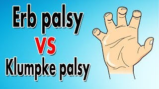 Erbs Palsy explained Brachial Plexus Injury [upl. by Longtin944]