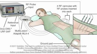 Introduction of an alternative radiofrequency technique for sacroiliac joint  Video Abstract 129478 [upl. by Kraul]