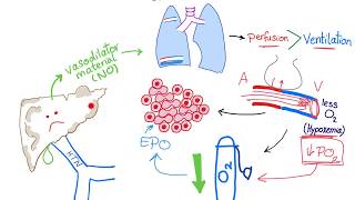 Hepatopulmonary syndrome [upl. by Adnalu300]