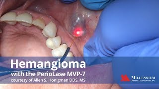 Hemangioma treatment with the PerioLase MVP7 [upl. by Ungley]