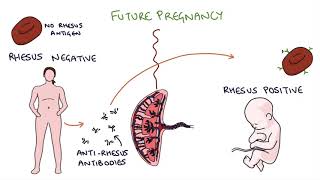 Understanding Rhesus Status and AntiD in Pregnancy [upl. by Wivestad792]