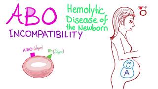 ABO Incompatibility  Hemolytic Disease Of The Newborn HDN  Hematology amp Pathology [upl. by Nitza993]