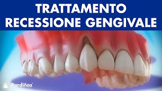 Gengive ritirate  Trattamento recessione gengivale © [upl. by Spears]