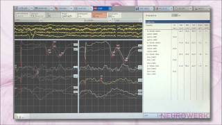 Evoked Potentials  SEP Tibial Nerve [upl. by Zollie992]