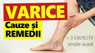 Cum SCAPI de VARICE Cauze Remedii  3 exerciţii SIMPLE acasă [upl. by Essilrahc]