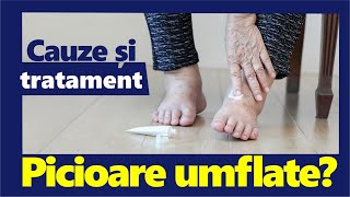 Picioare UMFLATE Cauze și Tratament [upl. by Clie]