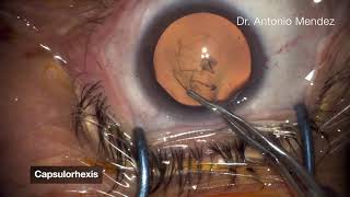 LASIK  Refractive Surgery  understand the procedure [upl. by Marduk]