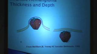 Laser Treatment for Hemangiomas Sorting Through the Myths [upl. by Aimac]